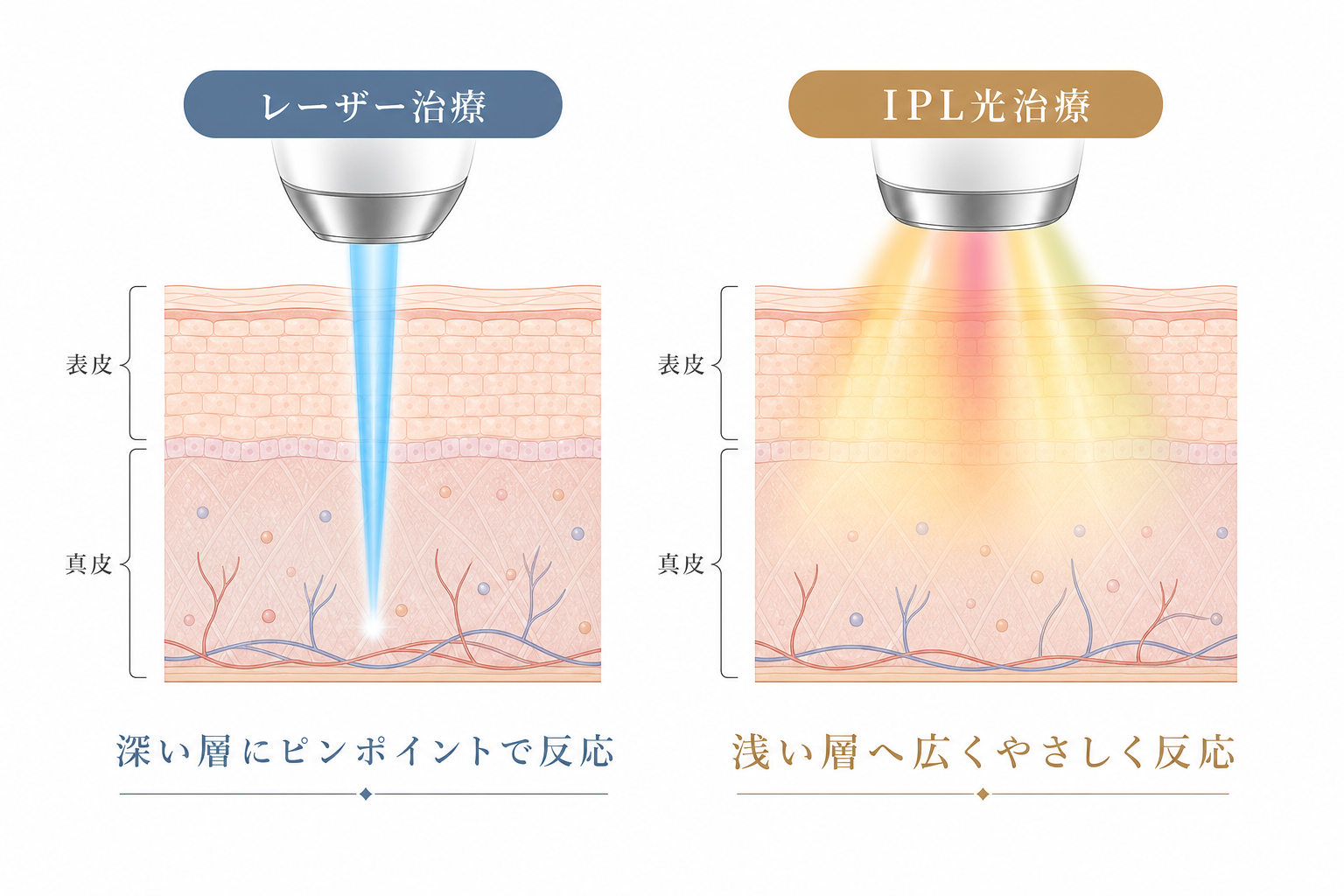 レーザー治療とIPL光治療の比較図