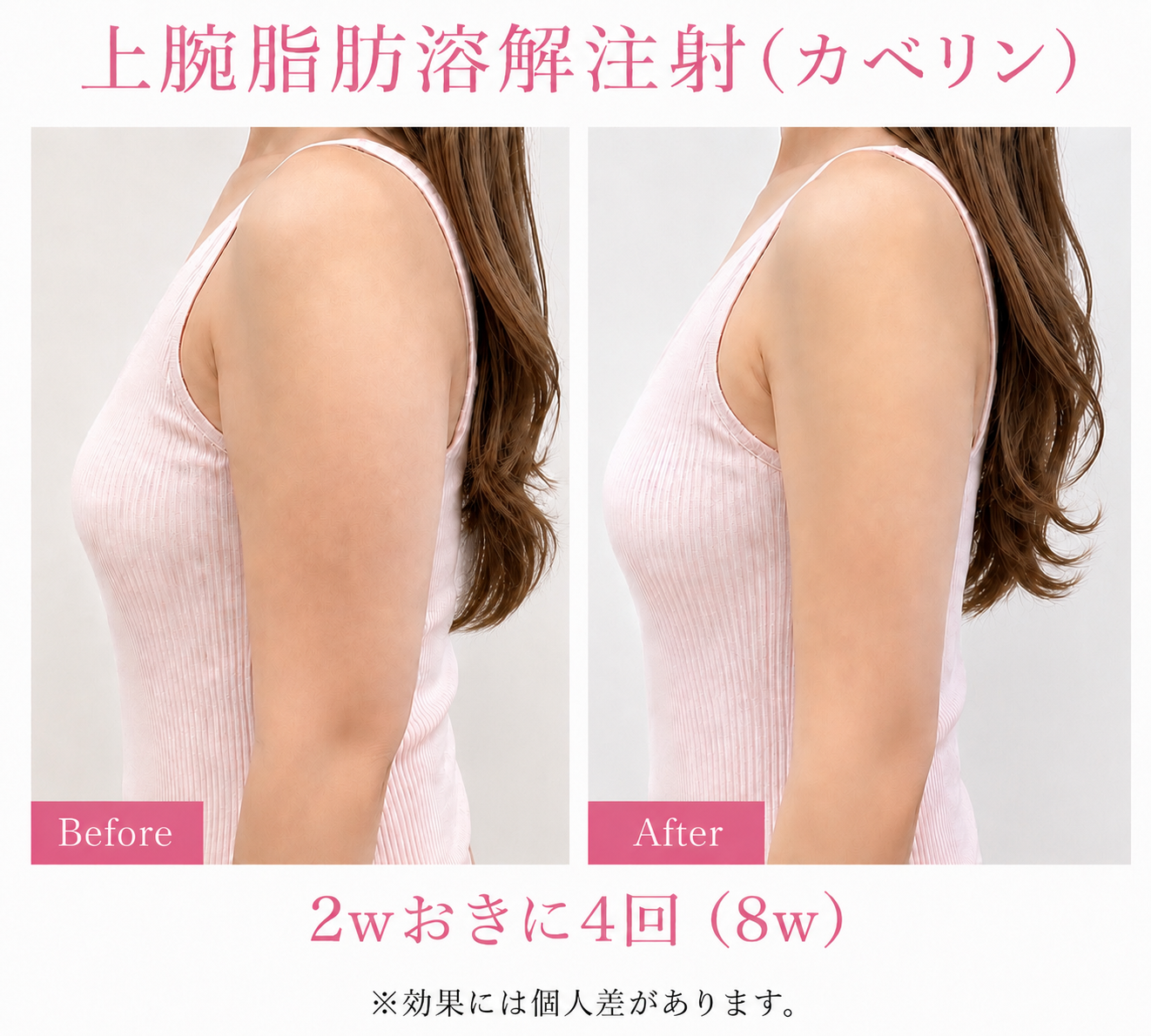 二の腕の症例写真